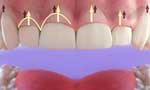 удлинение коронковой части зуба
